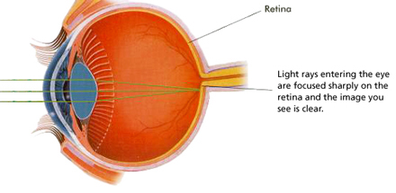 With normal vision, the cornea and the lens focus light directly onto the retina